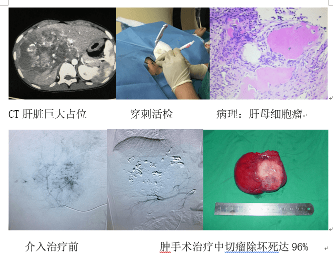 介入科醫(yī)生李炯：兒童出血性疾病、實體惡性腫瘤的介入治療