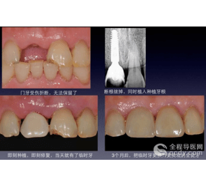 門(mén)牙即刻種植、即刻修復(fù) 避免缺牙尷尬