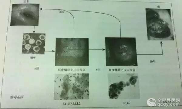 等了10年！宮頸癌疫苗終于要在內(nèi)地上市，就在明年年初！轉(zhuǎn)給身邊所有的女性！