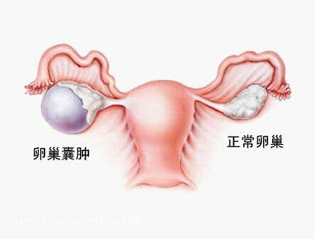 卵巢囊腫可保留卵巢功能微創(chuàng)治療 術后需定時復查以防復發(fā)