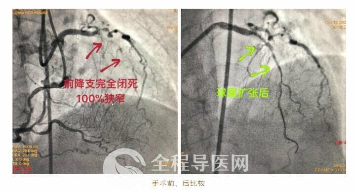 徐州市三院心臟團(tuán)隊(duì)于長城心臟病學(xué)大會(huì)CTO論壇直播超高難度冠心病介入手術(shù)