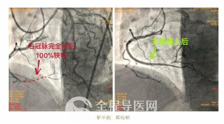 徐州市三院心臟團(tuán)隊(duì)于長城心臟病學(xué)大會(huì)CTO論壇直播超高難度冠心病介入手術(shù)