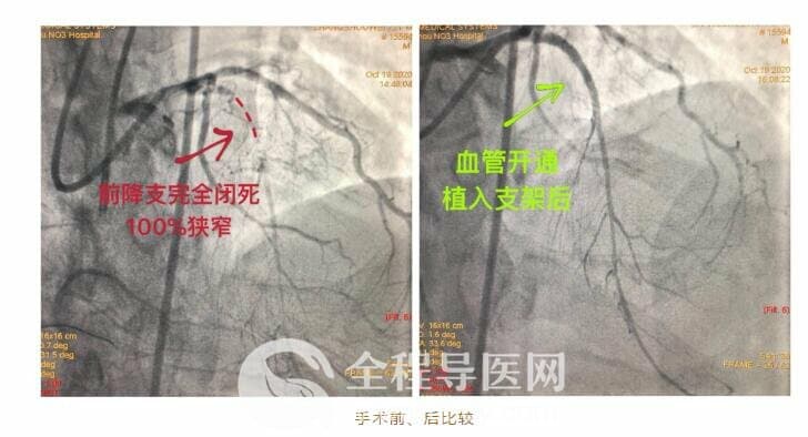 徐州市三院心臟團(tuán)隊(duì)于長城心臟病學(xué)大會(huì)CTO論壇直播超高難度冠心病介入手術(shù)