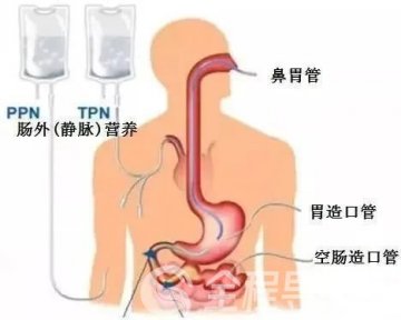 徐州一院重癥醫(yī)學(xué)科：營養(yǎng)治療的重要性，你了解嗎？